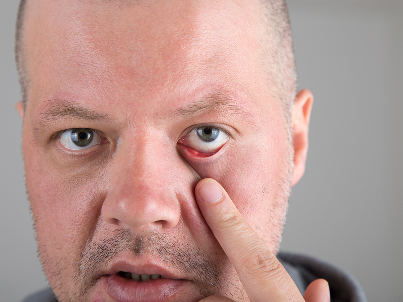 PODCAST: Blepharitis