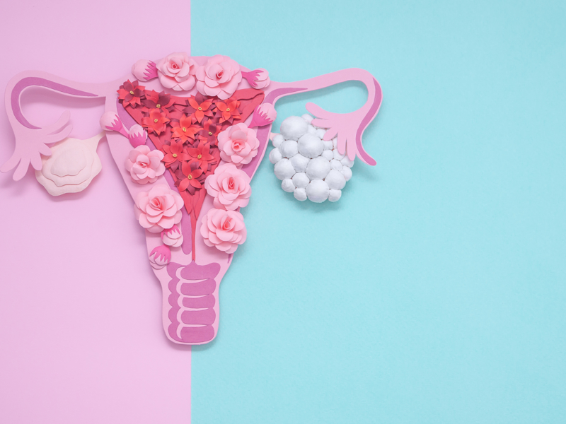 PCOS in General Practice - Podcast