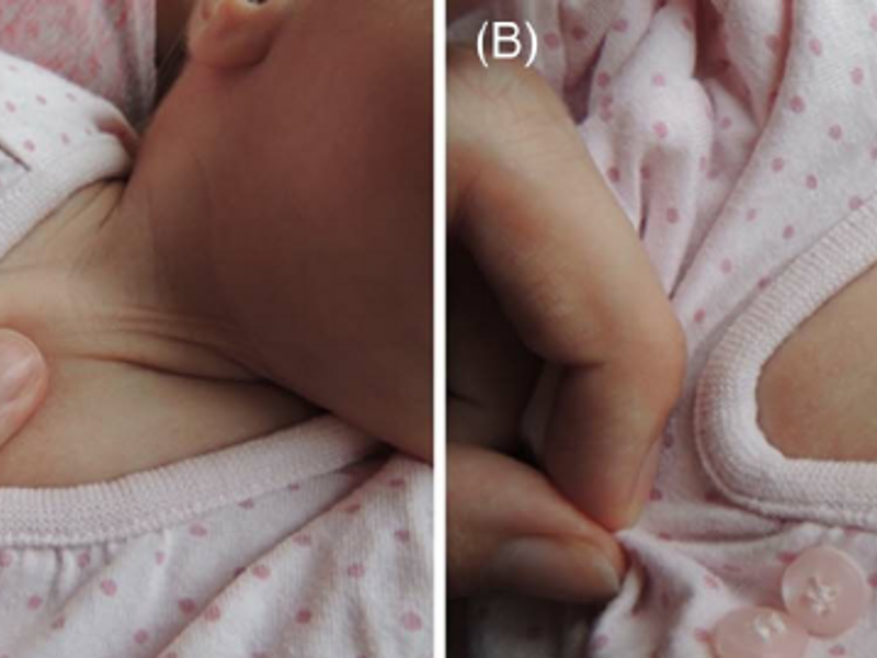 Central Capillary Refill Time in Paediatrics