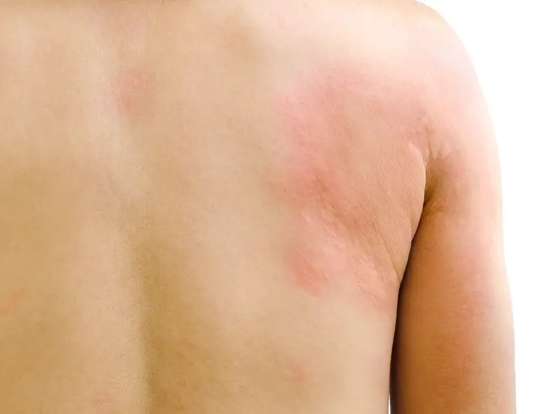 KISS - Urticaria