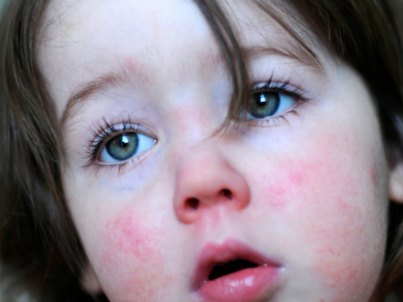 Clinical Opal - A child with a rash