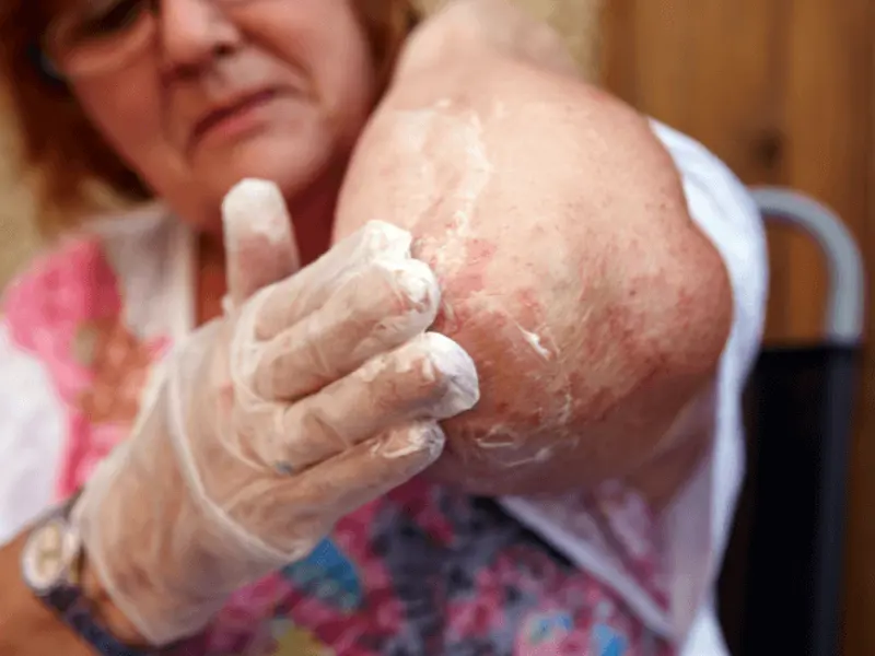 If you only knew what life is really like for patients with eczema