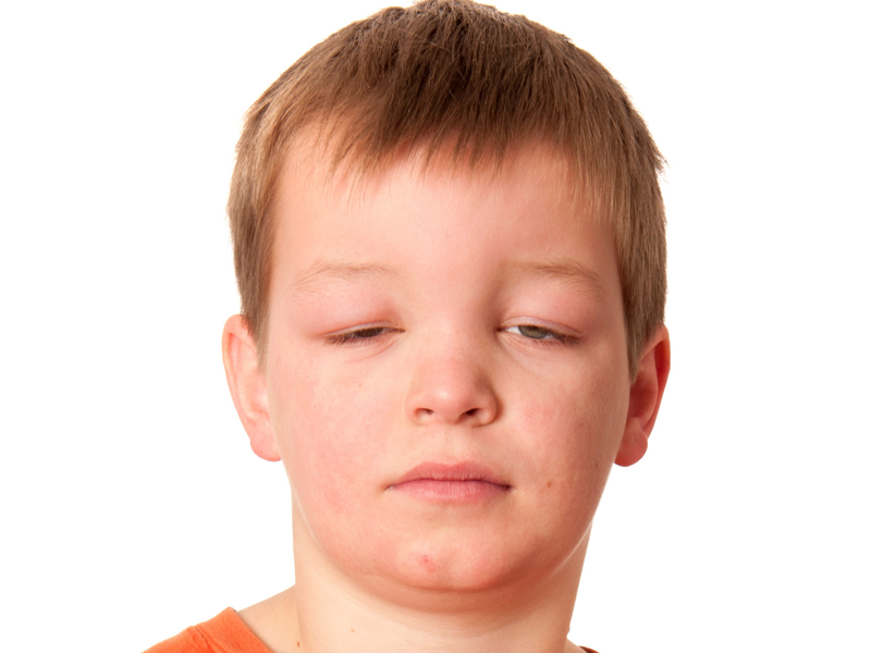 Clinical Opal - Marty presents with throat tightness following an insect bite
