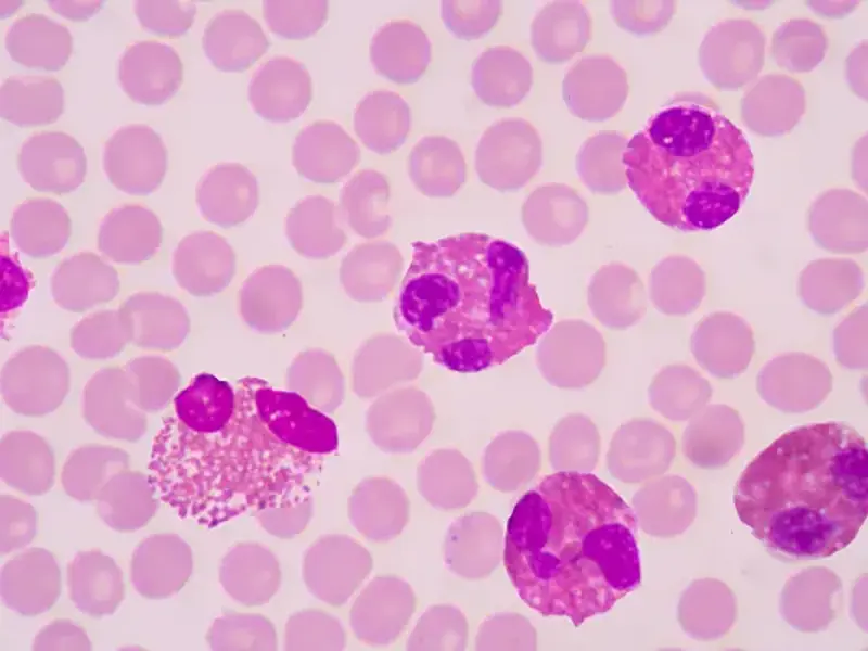 Eosinophilic oesophagitis - clinical fact sheet and MCQ