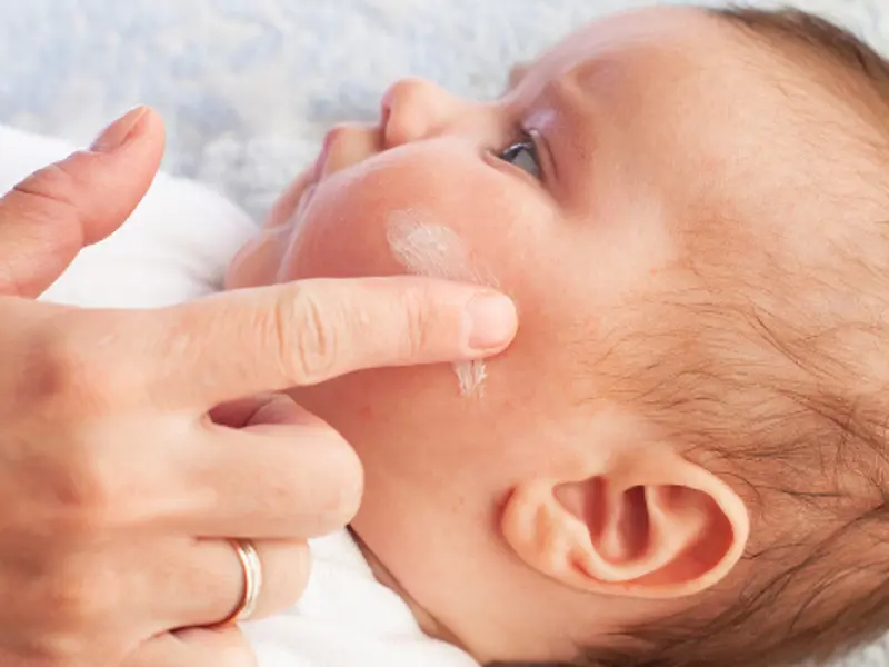 Optimising paediatric Eczema Care: A Nurses’ Guide