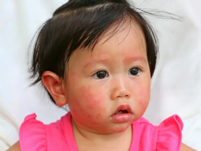 Does Hafiz need a referral for allergy testing?