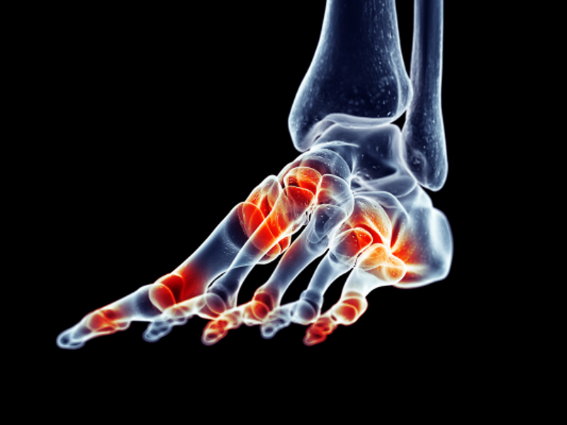 Gout - clinical essentials and MCQ