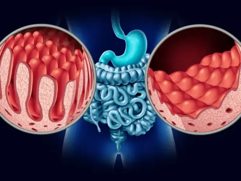 Crohn’s disease - clinical fact sheet and MCQ