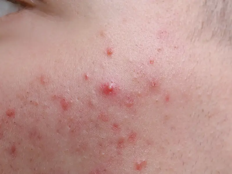 KISS - Acne Vulgaris