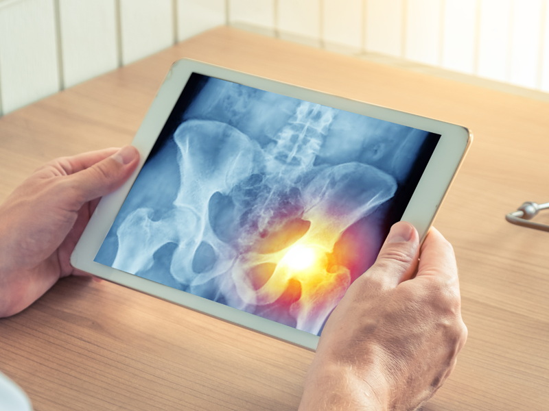 OA of the hip: The HIT Trial