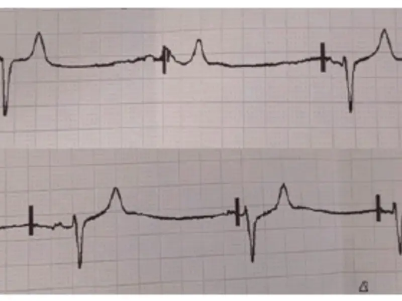 Managing pacing failure in post-operative cardiac surgery: causes and solutions