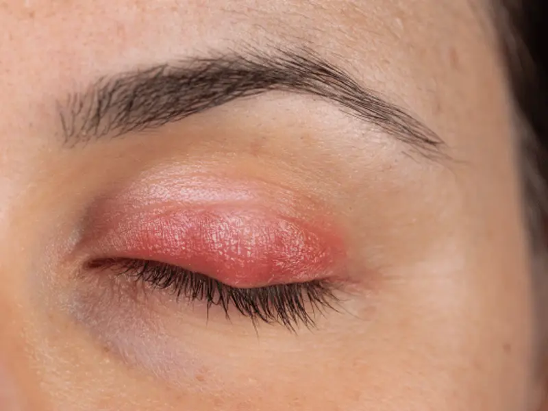 Chalazion - clinical fact sheet and MCQ