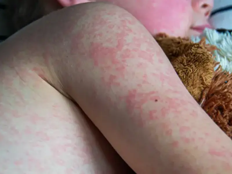 Measles - clinical fact sheet and MCQ 