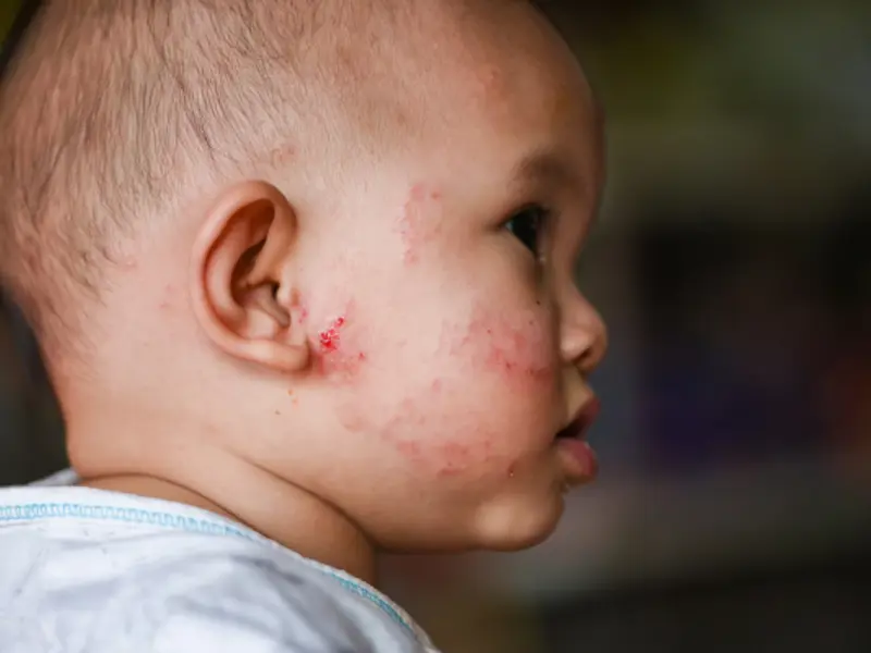 Facial eczema in an infant - Clinical Opal