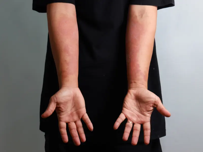 Beyond Skin Deep: Unravelling the challenges of managing eczema