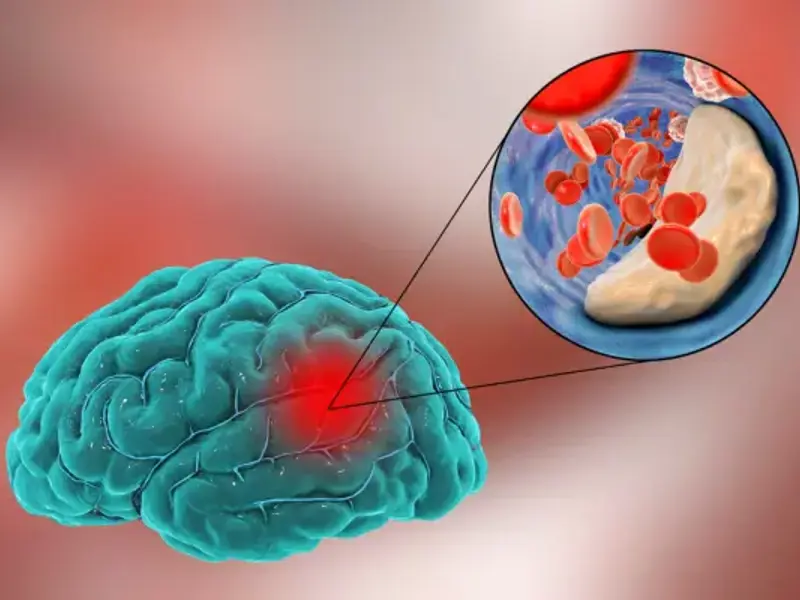 Atrial fibrillation stroke prevention - clinical fact sheet and MCQ