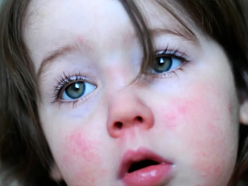 Clinical Opal - A child with a rash