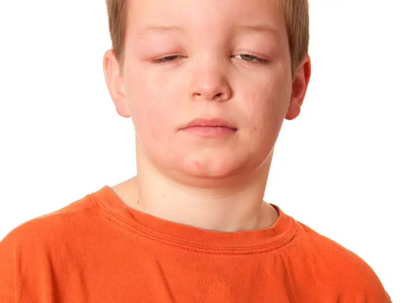 Clinical Opal - Marty presents with throat tightness following an insect bite